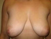 Patient # 20548 Before Photo # 1