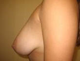 Patient # 20548 Before Photo # 5