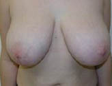 Patient # 37131 Before Photo # 1
