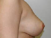 Patient # 25623 After Photo # 4
