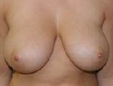 Patient # 25623 Before Photo # 1