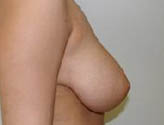 Patient # 25623 Before Photo # 3