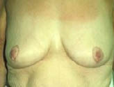 Patient # 67287 After Photo # 2