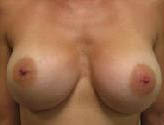 Patient # 12408 After Photo # 2