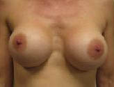 Patient # 12408 Before Photo # 1