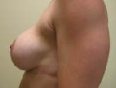 Patient # 12408 Before Photo # 5