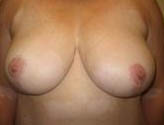 Patient # 12120 After Photo # 2