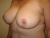 Patient # 12120 After Photo # 4