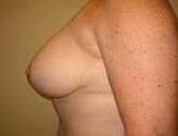 Patient # 12120 After Photo # 6