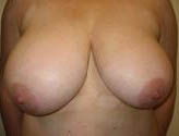 Patient # 12120 Before Photo # 1