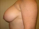 Patient # 12120 Before Photo # 5