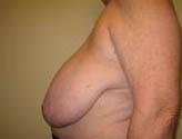 Patient # 88681 Before Photo # 5