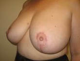Patient # 38406 After Photo # 4
