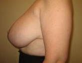 Patient # 38406 After Photo # 6
