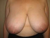 Patient # 38406 Before Photo # 1