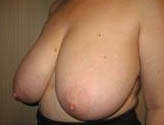 Patient # 38406 Before Photo # 3
