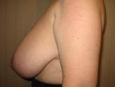 Patient # 38406 Before Photo # 5