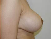 Patient # 96446 After Photo # 4