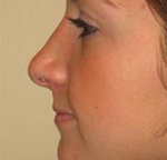 Patient # 18184 After Photo # 4