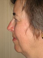 Patient # 97308 Before Photo # 5