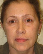 Patient # 96873 After Photo # 2