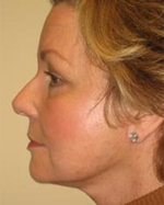 Patient # 11658 After Photo # 6