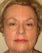 Patient # 11658 Before Photo # 1