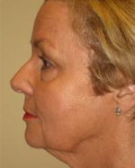 Patient # 11658 Before Photo # 5