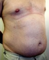 Patient # 22863 Before Photo # 1