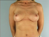 Patient # 84222 After Photo # 2