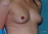 Patient # 66849 Before Photo # 3