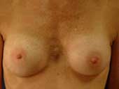 Patient # 40736 After Photo # 2