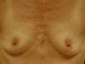 Patient # 40736 Before Photo # 1