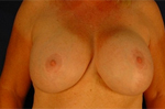 Patient # 12043 After Photo # 2