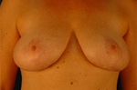 Patient # 28333 After Photo # 2