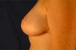Patient # 28333 After Photo # 4
