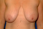 Patient # 28333 Before Photo # 1