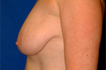 Patient # 28333 Before Photo # 3