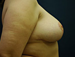 Patient # 74179 After Photo # 4