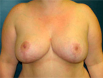 Patient # 12728 After Photo # 2