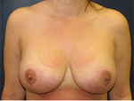 Patient # 38025 After Photo # 2