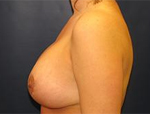 Patient # 38025 After Photo # 4