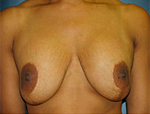 Patient # 28309 Before Photo # 1