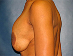 Patient # 28309 Before Photo # 3