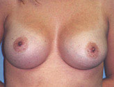 Patient # 63328 After Photo # 2