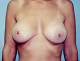 Patient # 43113 After Photo # 2