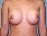 Patient # 44338 After Photo # 2