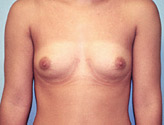 Patient # 44338 Before Photo # 1