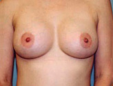 Patient # 82261 After Photo # 2