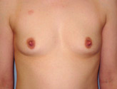 Patient # 82261 Before Photo # 1